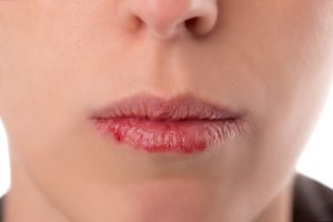 Up close picture of person's dry, cracked lips from xerostomia