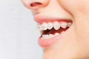 A close-up view of a person's mouth that has clear, ceramic braces on the teeth.