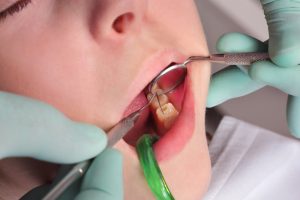 Close-up view of a child's mouth that is receiving a dental examination in a dental office.