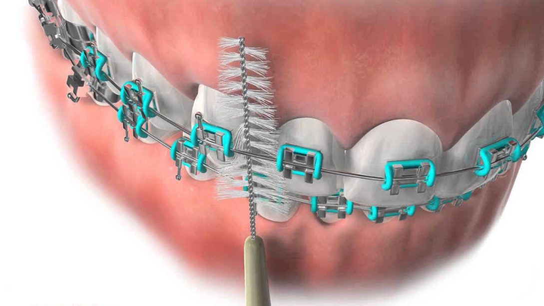 Patient Education Hardy Pediatric Dentistry Orthodontics