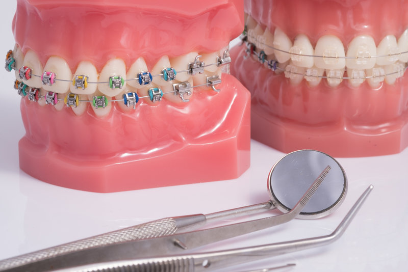 decayed teeth with braces