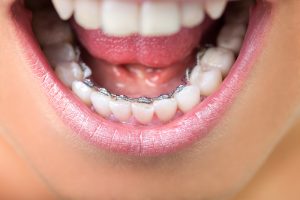Young woman showing mouth open with lingual braces