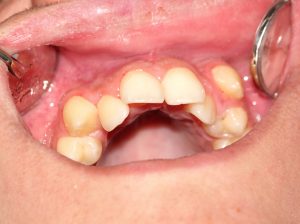 Picture of child's mouth and overcrowded and misshaped teeth
