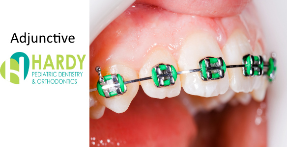What Advantages Do Lingual Braces Have Over Traditional? - Hardy