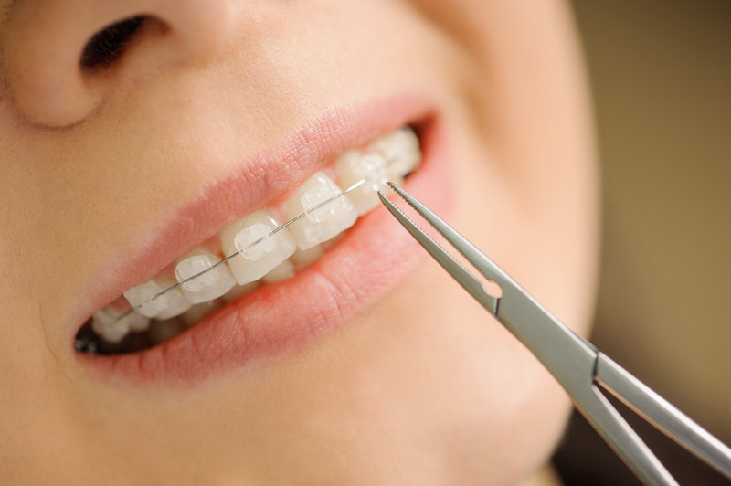 Ceramic Braces vs. Traditional Metal Braces - Hardy Pediatric Dentistry &  Orthodontics